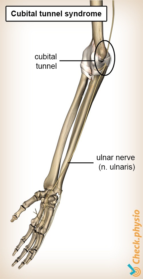 arm Kubitaltunnel Nervus ulnaris