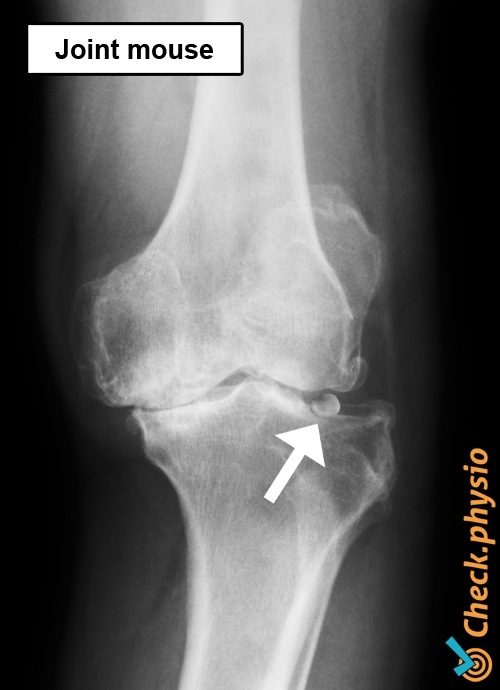 Corpus liberum Knie Röntgenbild