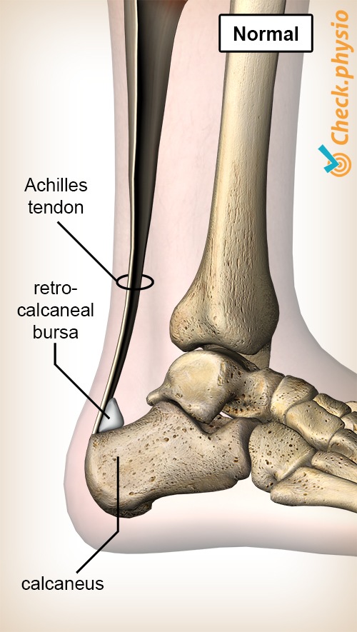 Sprunggelenk Achillessehne Bursa Retrocalcanea Fersenbein Calcaneus