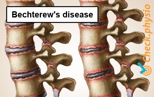 rückenspezifische untere Rückenschmerzen Morbus Bechterew Spondylitis ankylosans