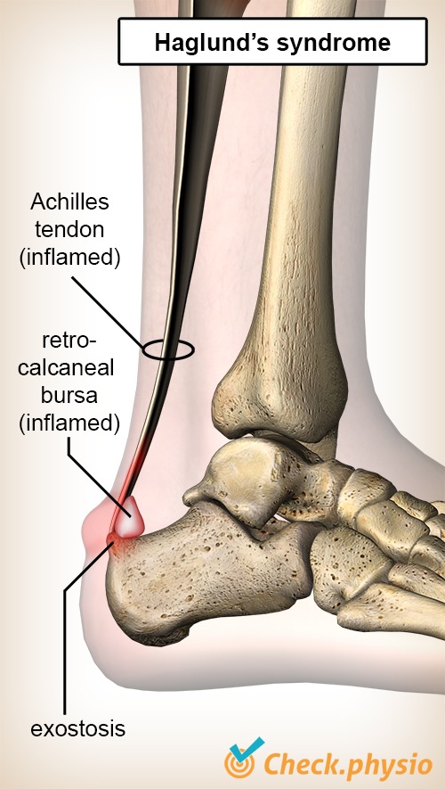 Sprunggelenk Haglund-Syndrom Achillessehne Bursa Retrocalcanea Fersenbein Calcaneus