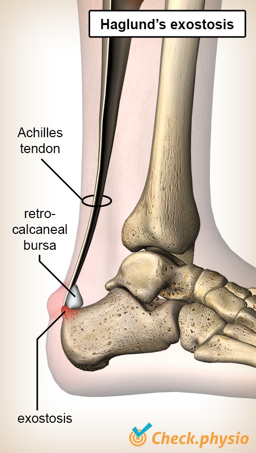 Sprunggelenk Haglund-Exostose Deformität Achillessehne Bursa Retrocalcanea Fersenbein Calcaneus