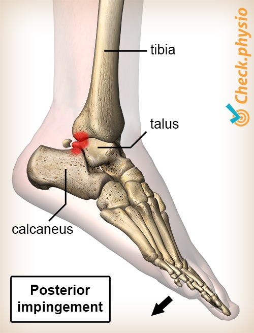 Sprunggelenk hinteres Impingement Plantarflexion