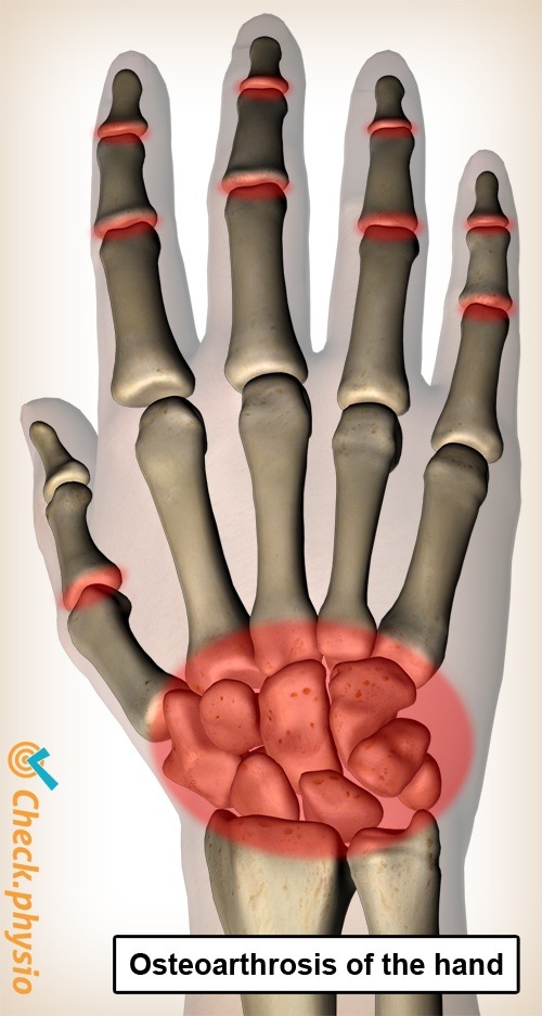 Handarthrose Schmerzorte