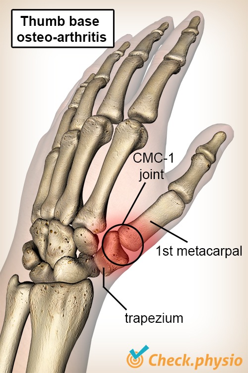 Hand Daumen Daumengrundgelenk Arthrose Os Trapezium Mittelhandknochen Metacarpale I CMC 1 Gelenk