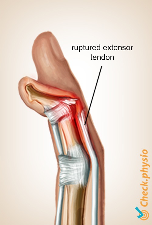 Hand Malletfinger Anatomie