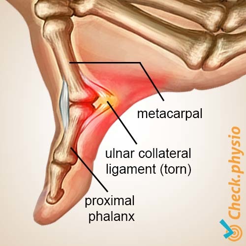 Hand Skidaumen Anatomie Ligamentum collaterale ulnare