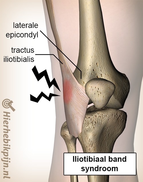 Knie Iliotibialband-Syndrom laterale Epikondyle