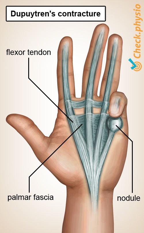 Hand Dupuytren-Krankheit Aponeurosis palmaris Knötchen