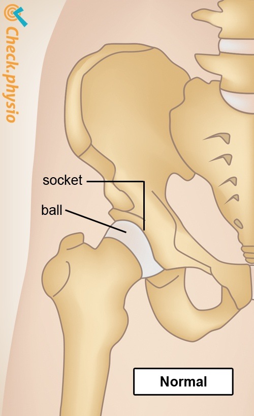 Hüfte Arthrose gesund