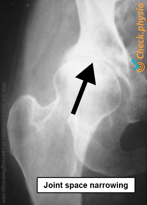 Hüfte Arthrose Röntgen Gelenkspalt