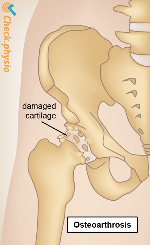 Hüfte Arthrose