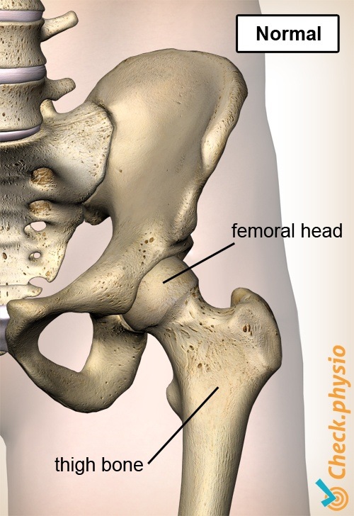 Hüfte Epiphysiolysis Capitis Femoris normal