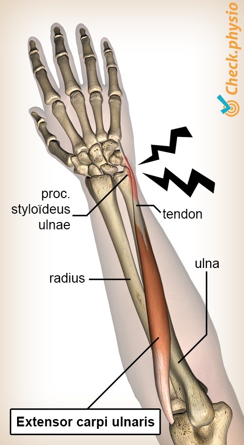 Arm Unterarm Extensor carpi ulnaris Tendinitis Tendinopathie