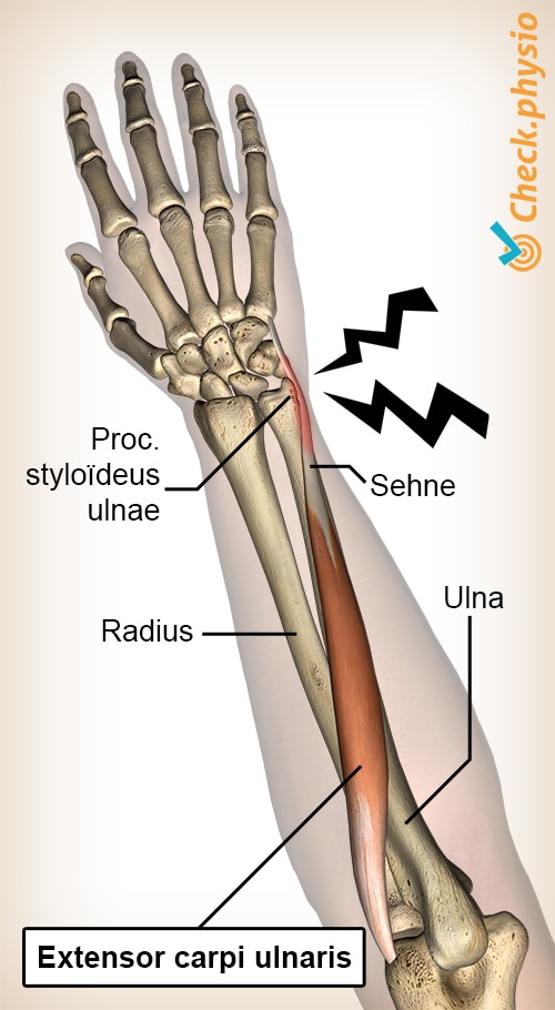 Arm Unterarm Extensor Carpi Ulnaristendinitis Tendinopathie