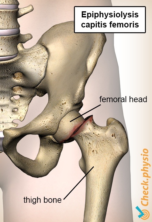 Hüfte Epiphysiolysis Capitis Femoris