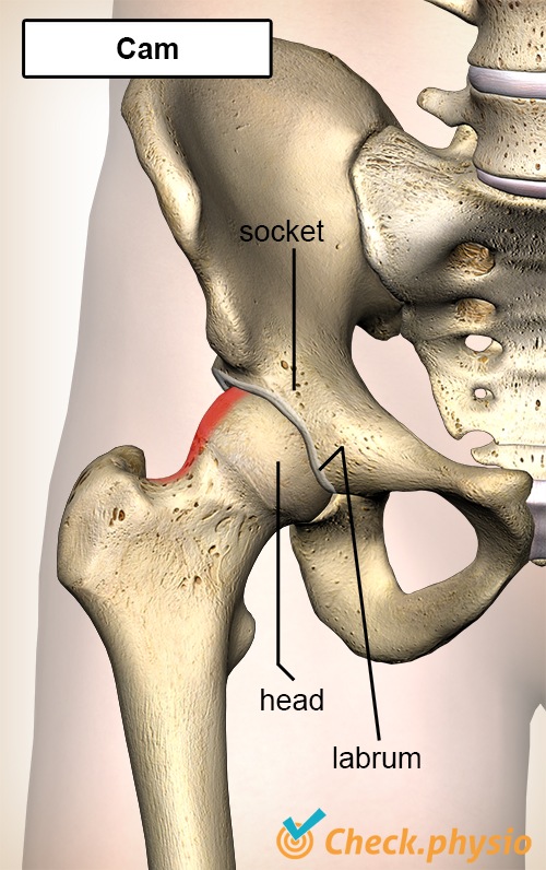 Hüfte Femoroacetabuläres Impingement FAI Cam