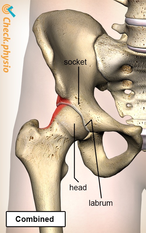 Hüfte Femoroacetabuläres Impingement FAI gemischt kombiniert