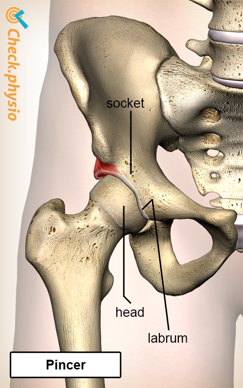 Hüfte Femoroacetabuläres Impingement FAI Pincer