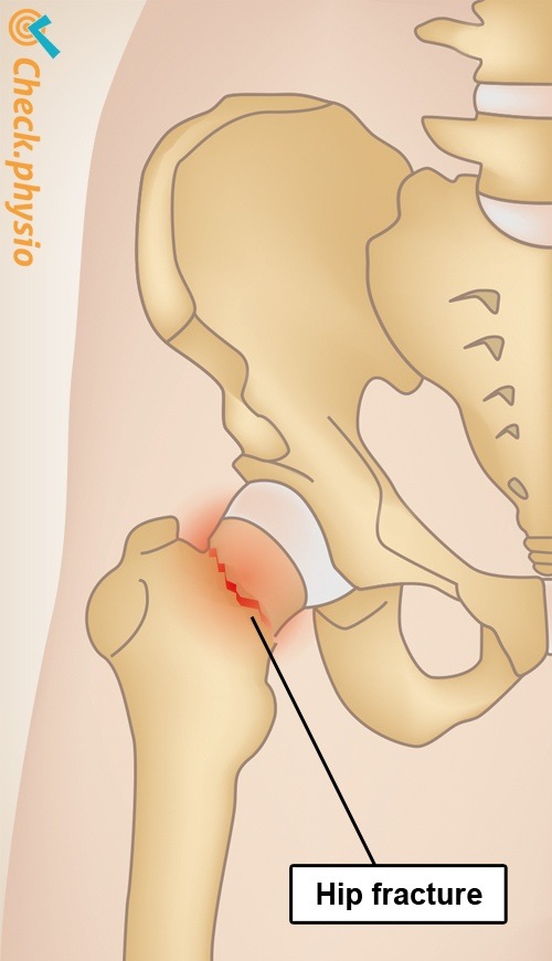 Hüfte Hüftfraktur Anatomie