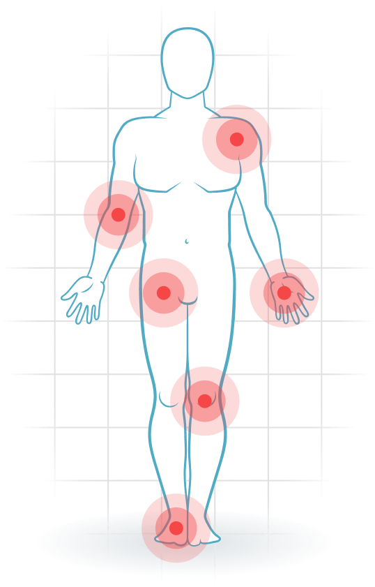 pijnlocatie Rheuma (rheumatoide Arthritis)