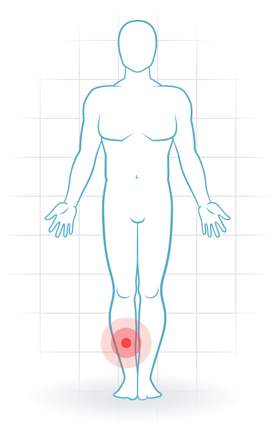 pijnlocatie Mediales Tibiastress-Syndrom