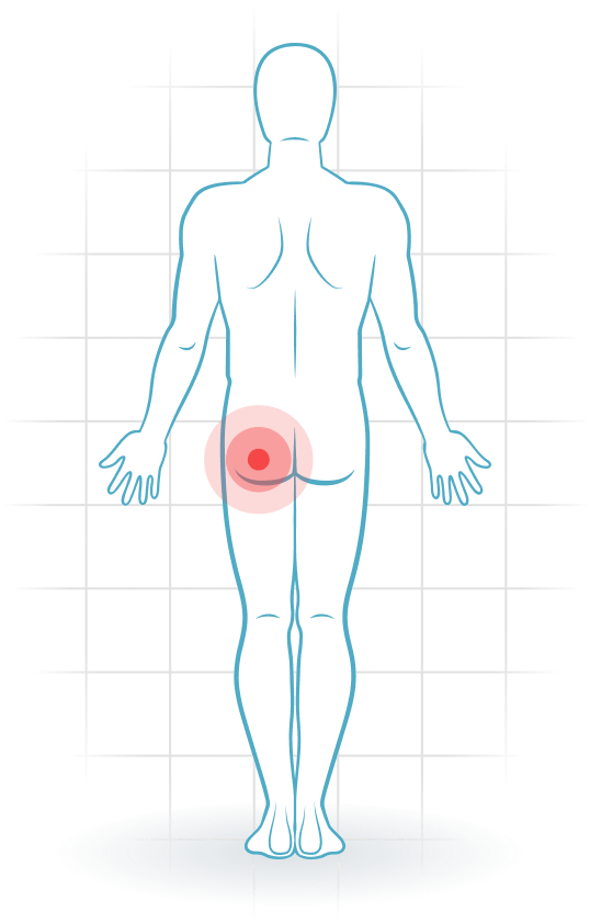 pijnlocatie Piriformis-Syndrom